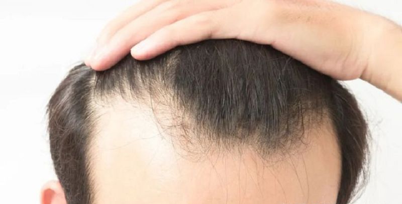 额角脱发的原因是什么？能否通过植发治疗？