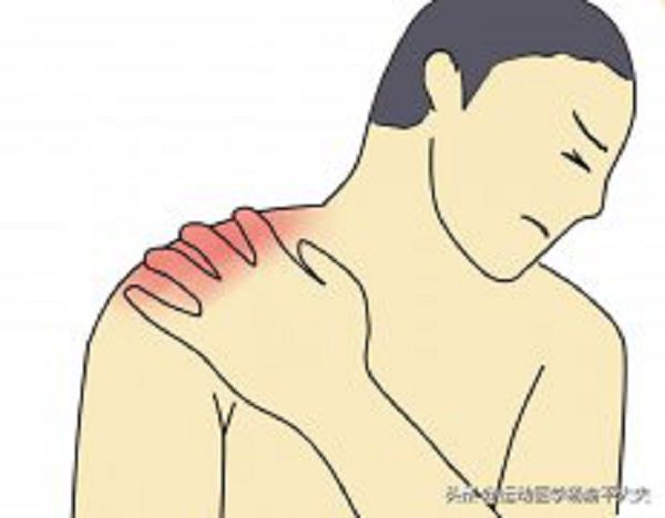 详解肩周炎的治疗方法